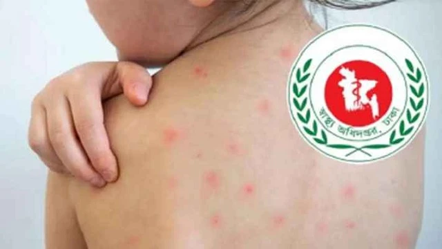 গাজীপুরে হামের উপসর্গ নিয়ে দুই শিশুর মৃত্যু