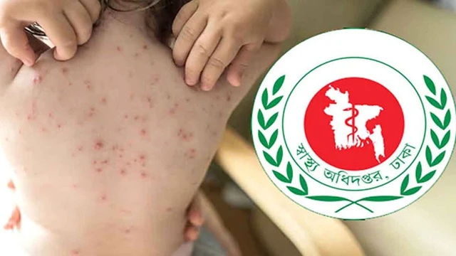 একমাসে হাম ও হাম সন্দেহে ১৯৮ শিশুর মৃত্যু